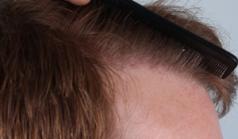 Before Hair Transplant&nbsp;Hairlines